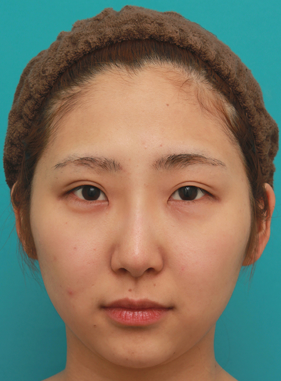 隆鼻注射（ヒアルロン酸注射）,眉間から鼻にかけて長期持続型ヒアルロン酸を注射し、綺麗に鼻筋を通した20代女性の症例写真,After（注射後1週間）,ba_ryubichusha54_a01.jpg