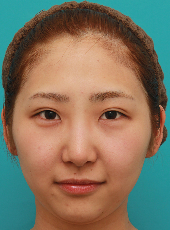 隆鼻注射（ヒアルロン酸注射）,眉間から鼻にかけて長期持続型ヒアルロン酸を注射し、綺麗に鼻筋を通した20代女性の症例写真,Before,ba_ryubichusha54_b.jpg