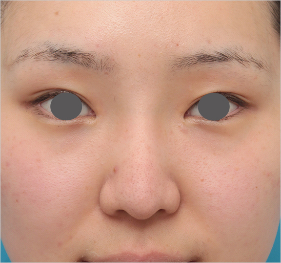 鼻シリコンプロテーゼ+鼻先耳介軟骨移植の症例写真の腫れが引いていくダウンタイム経過画像,After（6ヶ月後）,ba_ryubi79_a.jpg