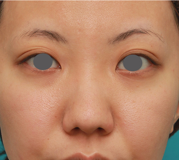 隆鼻注射（ヒアルロン酸注射）,凹凸のない平らな顔に長期持続型ヒアルロン酸を注射し、鼻筋を通した症例　術前術後画像,Before,ba_ryubi2027_b01.jpg