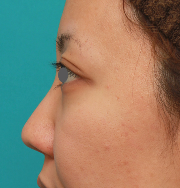 隆鼻注射（ヒアルロン酸注射）,凹凸のない平らな顔に長期持続型ヒアルロン酸を注射し、鼻筋を通した症例　術前術後画像,Before,ba_ryubi2027_b03.jpg