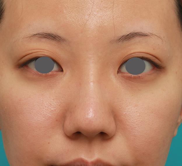 隆鼻注射（ヒアルロン酸注射）,凹凸のない平らな顔に長期持続型ヒアルロン酸を注射し、鼻筋を通した症例　術前術後画像,1ヶ月後,mainpic_ryubi2027d.jpg