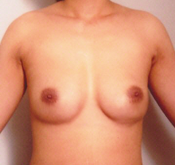豊胸手術（シリコンプロテーゼ）,他院で受けた手術の修正（豊胸・バスト・乳首）,他院で受けた豊胸手術（シリコンプロテーゼ）の修正症例　大胸筋下から乳腺下へ入れ替え,After,ba_modify07_a01.jpg