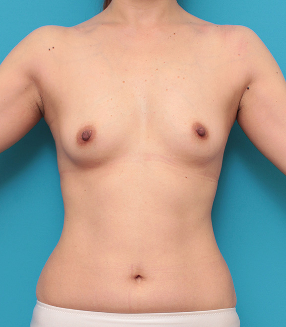 脂肪吸引,ピュアコンデンス脂肪注入豊胸,40代女性の細い身体の太もも全体から脂肪吸引し、バストに脂肪注入豊胸した症例写真,Before,ba_shibokyuin024_b01.jpg