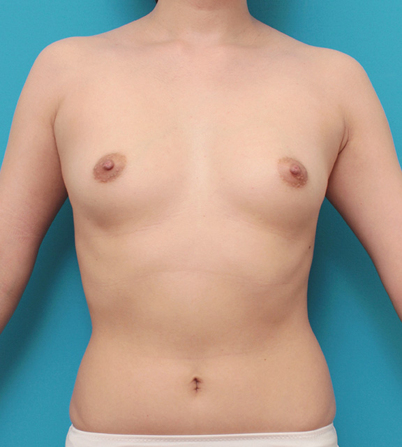 豊胸手術（シリコンプロテーゼ）,豊胸手術で乳腺下に245ccのシリコンプロテーゼを入れた症例写真,Before,ba_hokyo025_b01.jpg