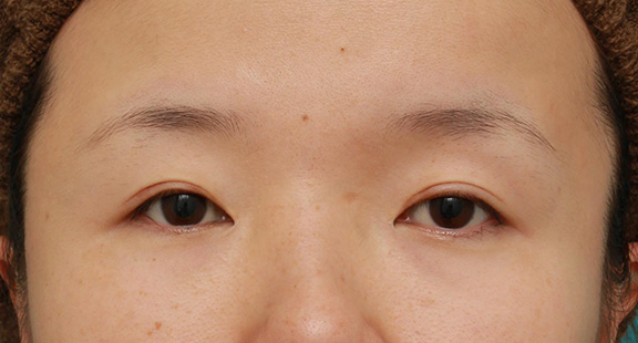 眼瞼下垂（がんけんかすい）,眼球自体が小さく開きも悪い目に対して、目頭切開+眼瞼下垂手術で目を一回り大きくした症例写真,After（6ヶ月後）,ba_megashira047_b01.jpg