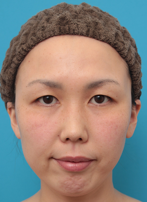 症例写真,二重まぶた埋没法2針固定でたるんでいる皮膚を持ち上げて目を大きくした30代女性の症例写真,手術前,mainpic_maibotsu036a.jpg