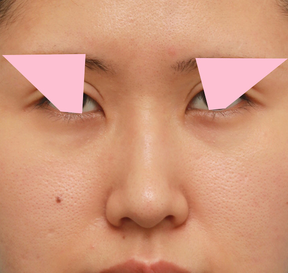 鼻翼縮小（小鼻縮小）,鼻の穴の内側から外側の途中にかけて切除するデザインで小鼻縮小した症例写真,After（6ヶ月後）,ba_biyoku042_a01.jpg