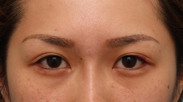 目尻切開,目尻切開で目を外側に大きくした20代女性の症例写真,1週間後,mainpic_mejiri015c.jpg