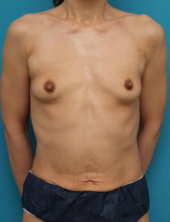 胸のシリコンプロテーゼ抜き（除去）,大胸筋下の生理食塩水バッグプロテーゼを抜いた症例写真,After（生理食塩水バッグ
プロテーゼ除去手術後）,ba_prosthesis_removal005_a01.jpg