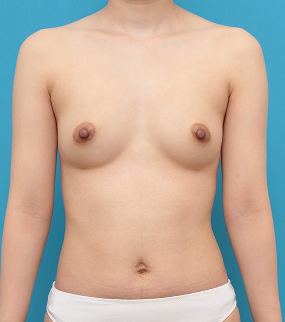 症例写真,痩せている女性の太もも、お尻から脂肪吸引し、バストに脂肪注入豊胸した症例写真,After（6ヶ月後）,ba_shibokyuin032_b01.jpg