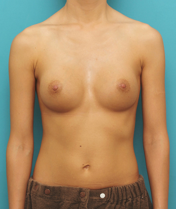 乳頭縮小,シリコンバッグプロテーゼ豊胸と乳頭縮小手術を同時に行った症例写真,After（6ヶ月後）,ba_hokyo026_b01.jpg