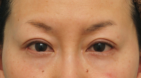 目尻切開,40代女性に目尻切開を行って目を外側に大きくした症例写真,After（7ヶ月後）,ba_mejiri017_a01.jpg