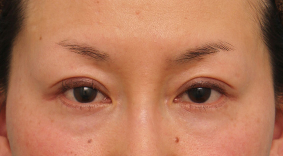 目尻切開,40代女性に目尻切開を行って目を外側に大きくした症例写真,Before,ba_mejiri017_b01.jpg