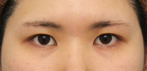 垂れ目（パンダ目）形成（グラマラスライン／下眼瞼下制術）,二重まぶた埋没法2針固定+タレ目形成（グラマラスライン）の症例写真,Before,ba_maibotsu039_b01.jpg