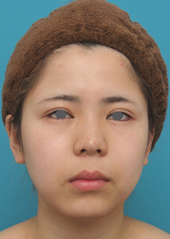 脂肪吸引（頬、あご）,頬、顎下の脂肪吸引をし、下膨れの顔の輪郭が改善した症例写真,After（6ヶ月後）,ba_shibo005_b01.jpg
