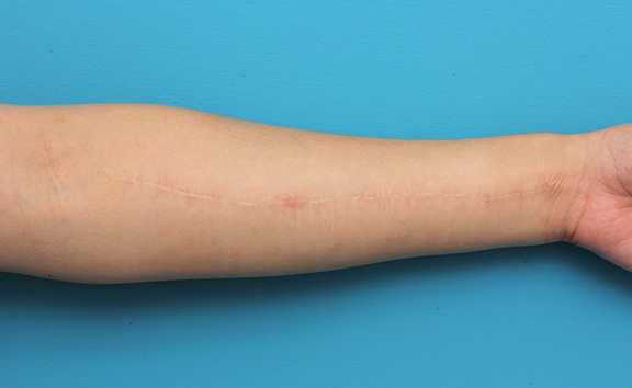 傷跡,リストカットの傷跡を2回に分けて切除縫合手術した症例写真,After（2回目手術後1年）,ba_keisei018_b01.jpg