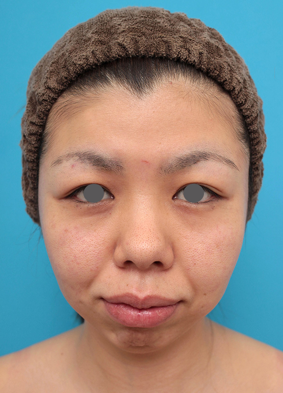 鼻尖形成（鼻尖縮小・だんご鼻修正）,鼻尖形成、耳介軟骨移植、顎プロテーゼ入れの症例写真,Before,ba_bisen029_b01.jpg