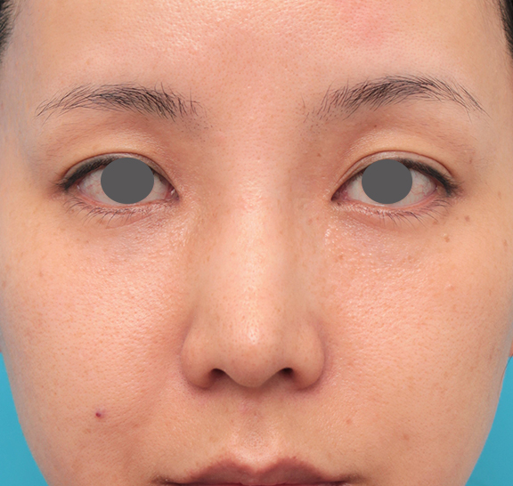 鼻先に耳介軟骨移植を行った30代女性の症例写真,Before,ba_jikai046_b01.jpg