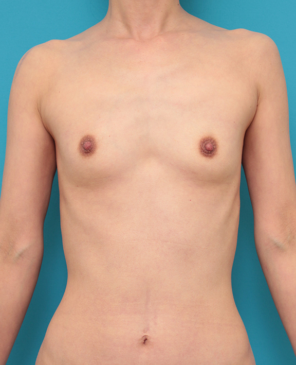 豊胸手術（シリコンプロテーゼ）,乳腺下に140ccのシリコンバッグプロテーゼを入れた40代女性の症例写真,Before,ba_hokyo037_b01.jpg