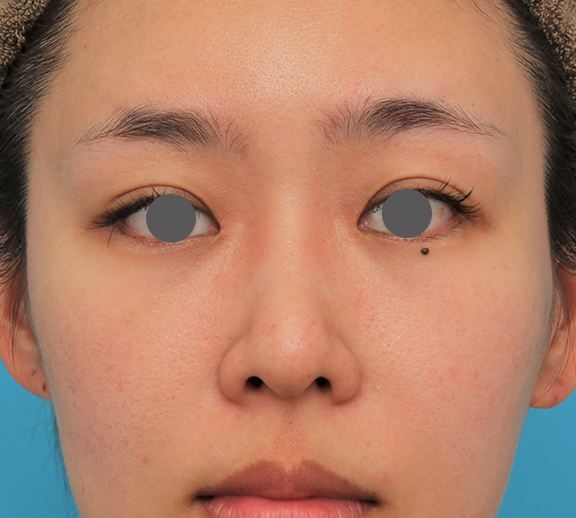 鼻尖形成（鼻尖縮小・だんご鼻修正）,ハンプ切除+鼻骨切り幅寄せ+鼻尖縮小を行った20代女性の症例写真,After（4ヶ月後）,ba_hump015_b01.jpg
