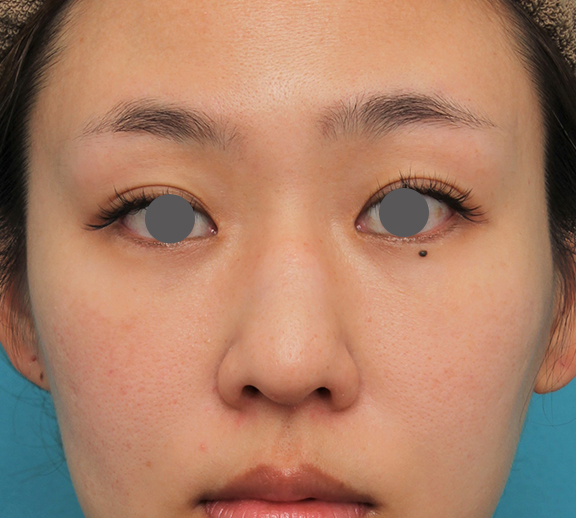 鼻尖形成（鼻尖縮小・だんご鼻修正）,ハンプ切除+鼻骨切り幅寄せ+鼻尖縮小を行った20代女性の症例写真,Before,ba_hump015_b01.jpg