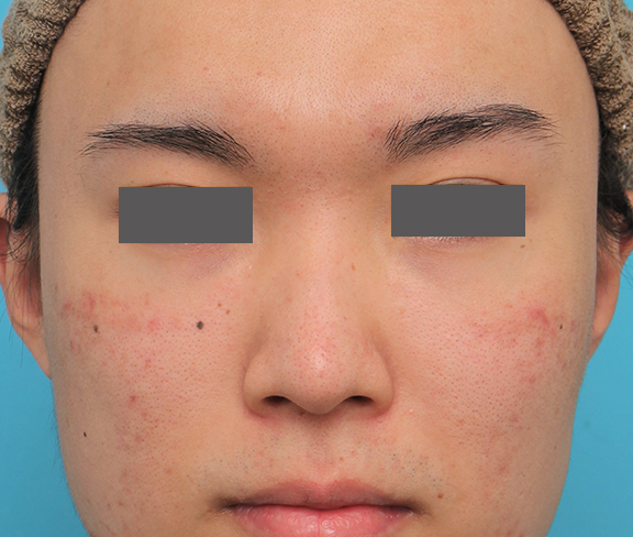 鼻翼縮小（小鼻縮小）,小鼻縮小手術を行った20代男性の症例写真,Before,ba_biyoku054_b01.jpg