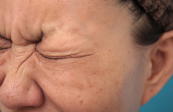 目尻のシワをボトックス注射で改善させた40代女性の症例写真,After（3ヶ月後）,ba_botox020_a01.jpg