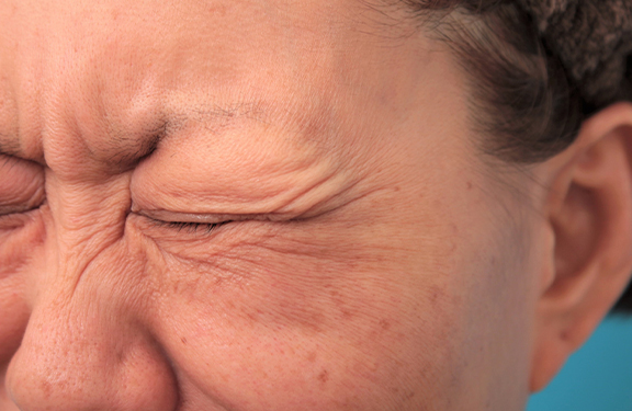 目尻のシワをボトックス注射で改善させた40代女性の症例写真,Before,ba_botox020_b01.jpg
