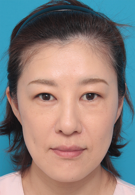 40代女性の顔と首にサーマクールを照射した症例写真症例写真 ： 美容皮膚科： 美容整形の高須クリニック