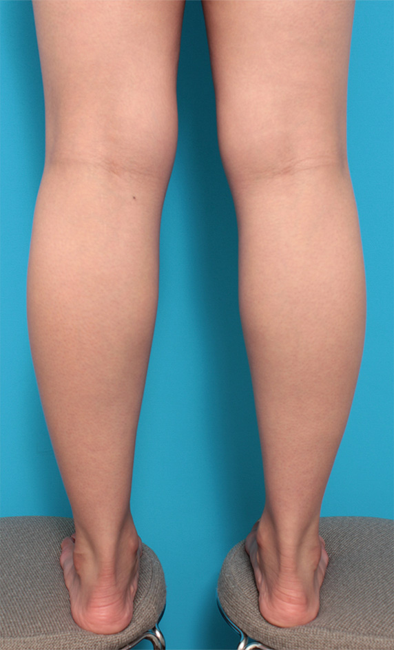 ボツリヌストキシン注射（ふくらはぎ・足やせ・美脚）でふくらはぎの筋肉を痩せさせて細くした症例写真の術前術後画像の解説症例写真 ： 脂肪吸引