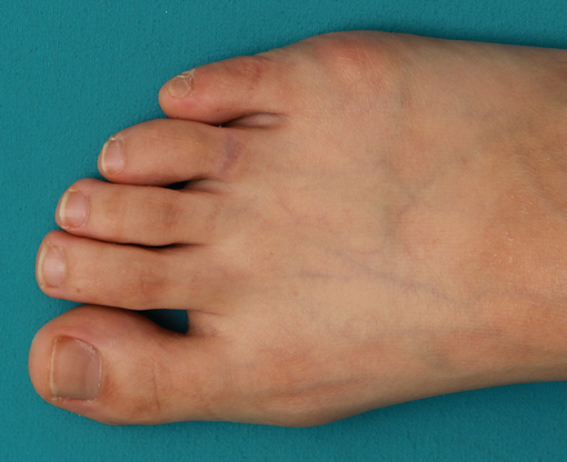自分で墨汁で入れた足の指の入れ墨をレーザーで除去した症例写真の術前術後画像症例写真 ： 入れ墨除去： 美容整形の高須クリニック