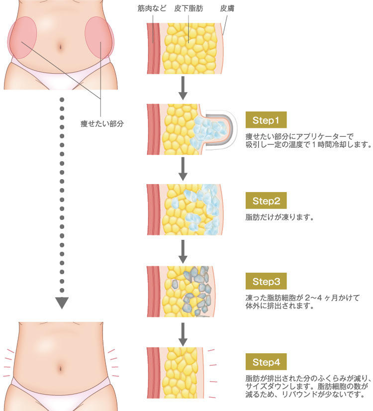 クールテック・ディファイン ： 脂肪吸引・痩身・部分痩せ：美容外科 高須クリニック