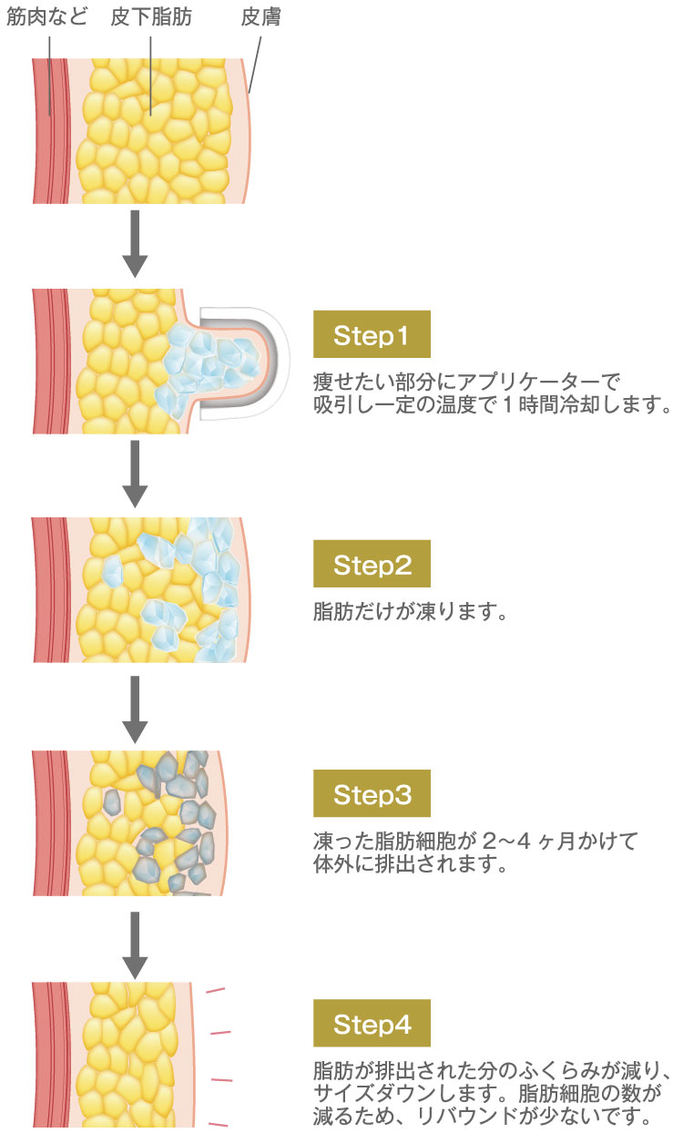 クールテック・ディファイン ： 脂肪吸引・痩身・部分痩せ：美容外科 高須クリニック