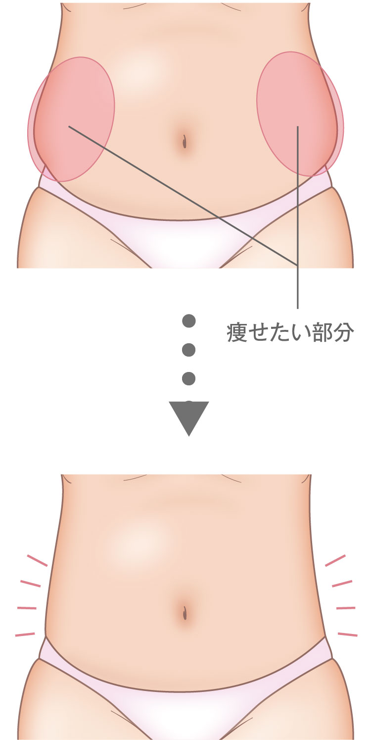 クールテック・ディファイン ： 脂肪吸引・痩身・部分痩せ：美容外科