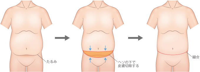 お腹のたるみ タルミ 妊娠線を消す腹リダクション 美容外科 高須クリニック