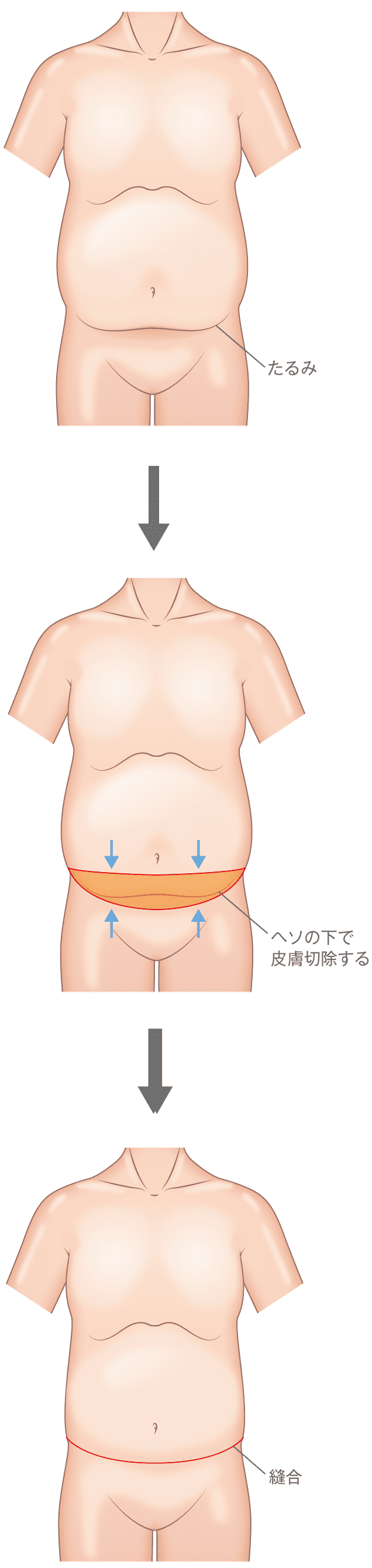 お腹のたるみ タルミ 妊娠線を消す腹リダクション 美容外科 高須クリニック