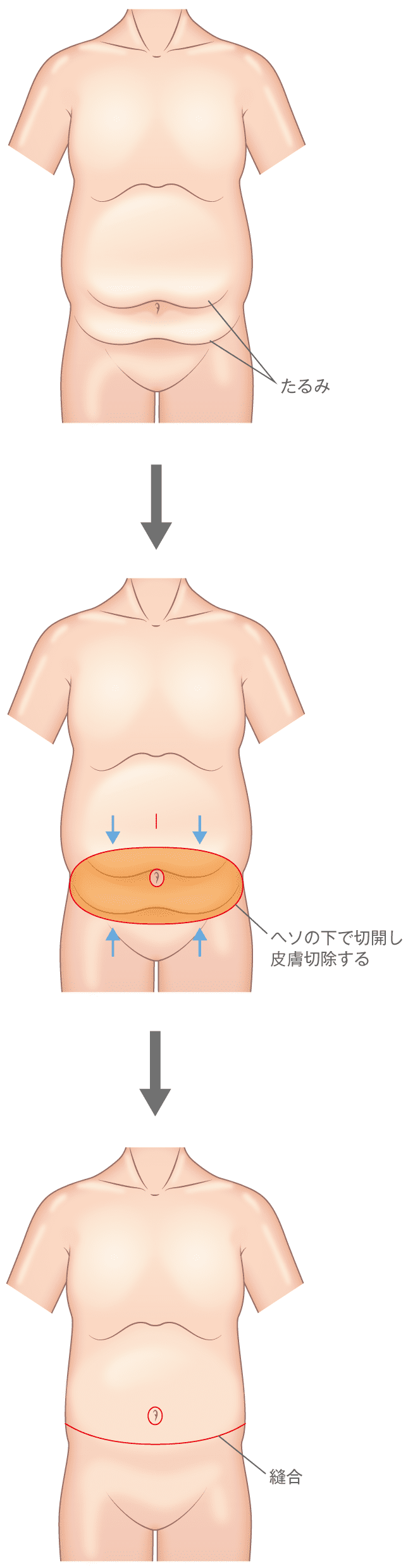 お腹のたるみ タルミ 妊娠線を消す腹リダクション 美容外科 高須クリニック