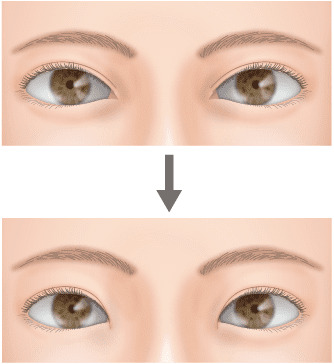 蒙古ひだの形成と修正で寄り目を治しやさしい印象に 美容外科 高須クリニック