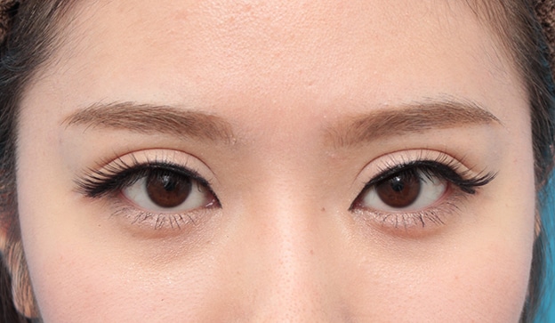 眼瞼下垂の手術で上瞼をひらきぱっちり大きな目に 高須クリニック