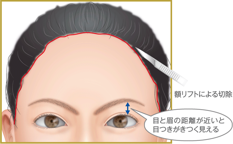 他院で受けた二重 目元の手術修正の症例や費用 高須クリニック