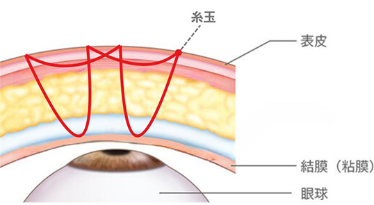 連続埋没法 表皮/糸玉/結膜（粘膜）/眼球