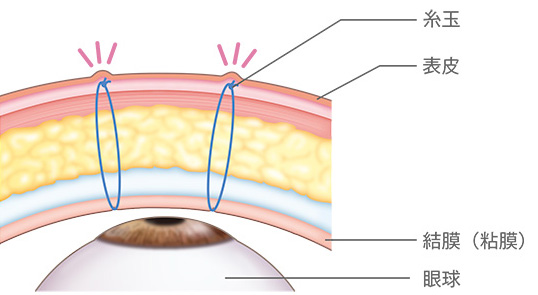 一般的な埋没法 表皮/糸玉/結膜（粘膜）/眼球
