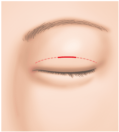 二重まぶた全切開法の特徴と手術内容 高須クリニック