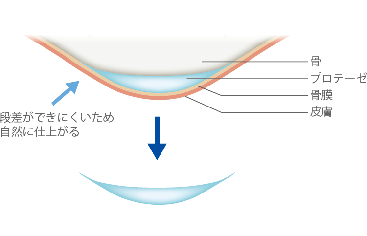 当院で使用しているプロテーゼ
