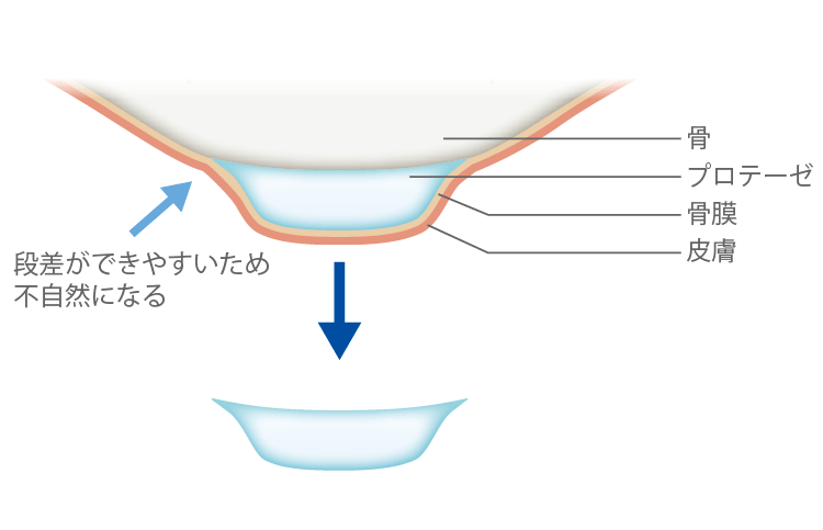 ※当院で使用していないプロテーゼ