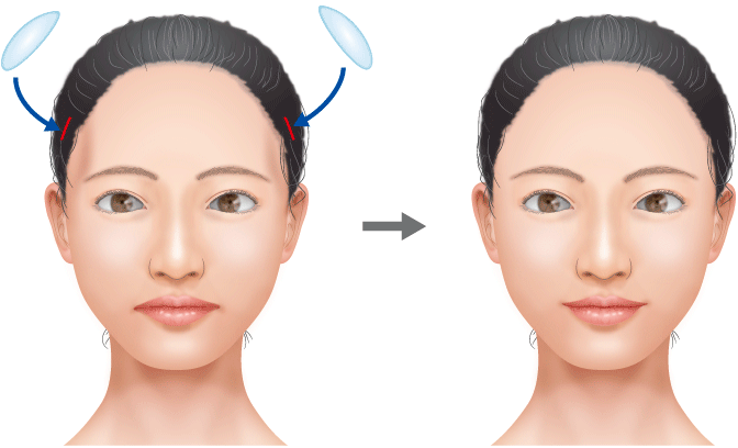 こめかみ形成（ふっくらさせる） ： あご（顎）・輪郭・小顔・フェイス