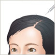 女性の薄毛治療
