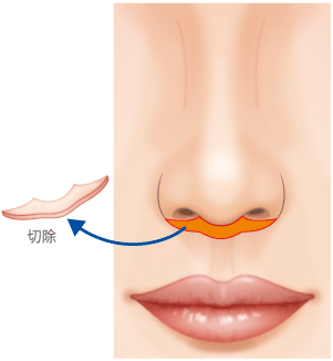 上口唇短縮手術で人中短縮 若々しい印象に 美容外科 高須クリニック