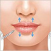 ヒアルロン酸で唇を厚く(ふっくら・アヒル口etc)